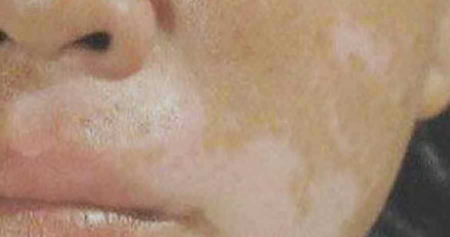 科學家揭開白癜風對稱分布之謎