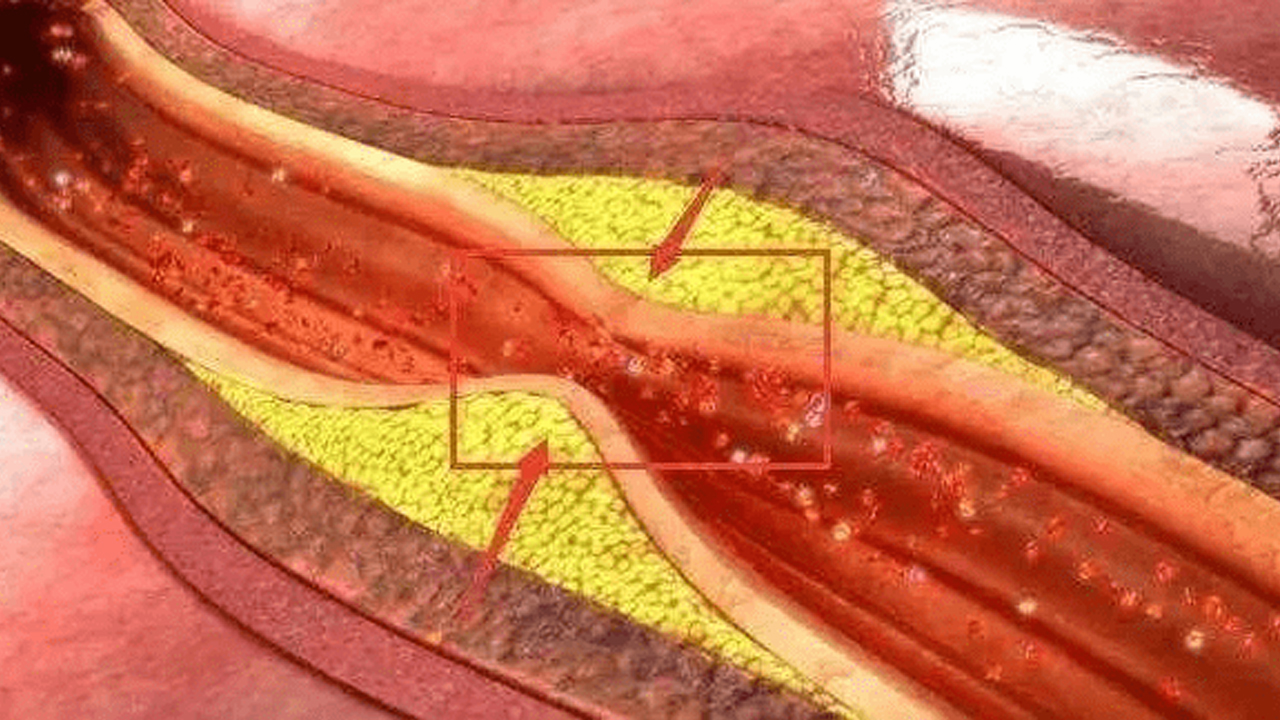 動脈粥樣硬化斑塊能與大腦“對話”