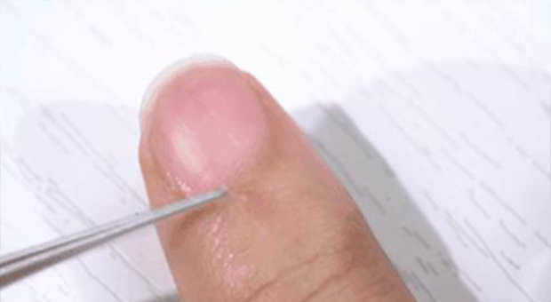 手上長倒刺是缺維生素？兩碼事兒！