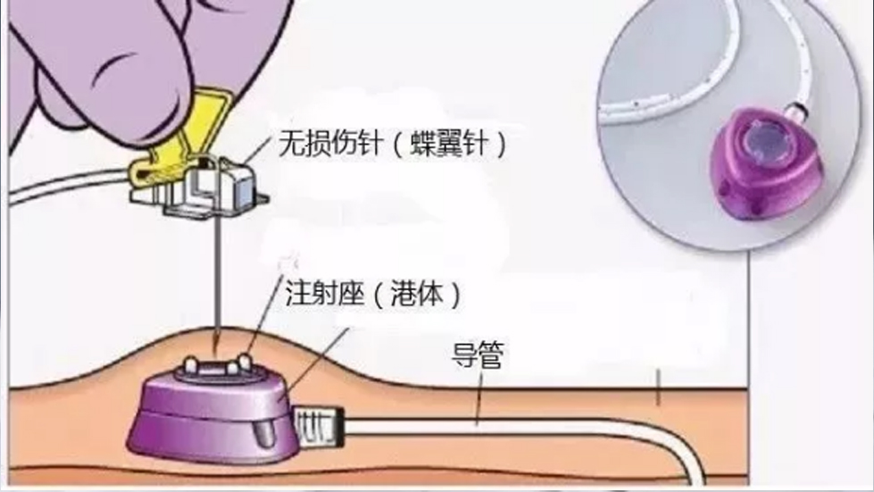 多學(xué)科協(xié)作破高齡治療難題，輸液港技術(shù)啟精準(zhǔn)醫(yī)療新篇--太原市第七人民醫(yī)院