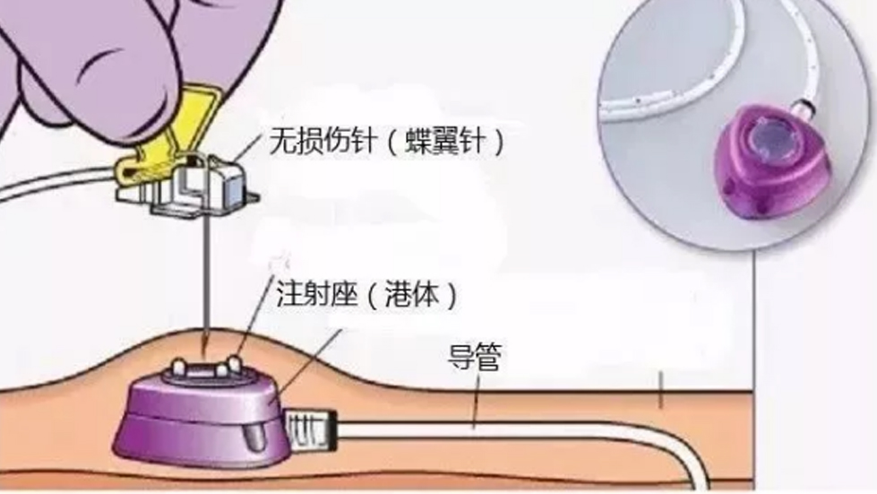 多學科協(xié)作破高齡治療難題，輸液港技術(shù)啟精準醫(yī)療新篇--太原市第七人民醫(yī)院以創(chuàng)新實踐守護患者健康