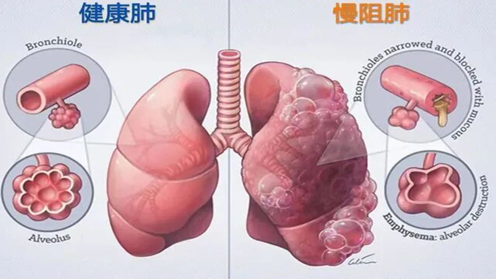 【醫(yī)院動態(tài)】了解你的肺功能